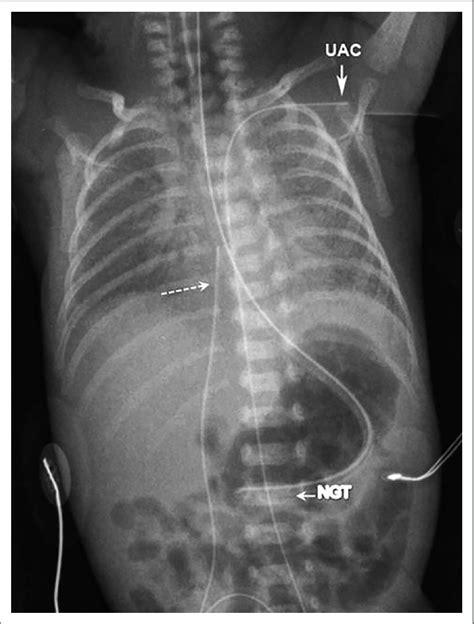 The umbilical arterial catheter (UAC) has been advanced too far. Its... | Download Scientific ...