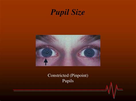 PPT - Concussion PowerPoint Presentation, free download - ID:525922