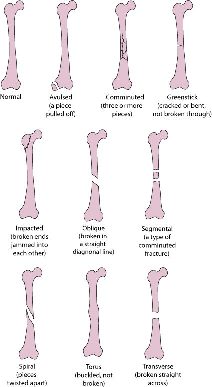 Overview of Fractures, Dislocations, and Sprains - Injuries and Poisoning - Merck Manuals ...