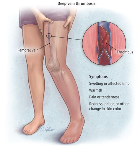 Deep Vein Thrombosis | Venous Thromboembolism | JAMA | JAMA Network