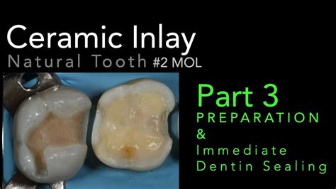 Lithium Disilicate Ceramics, Part 3: Preparation and Immediate Dentin Sealing (IDS) - YouTube