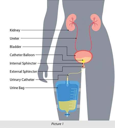 How to Care for Your Urinary Catheter | SingHealth