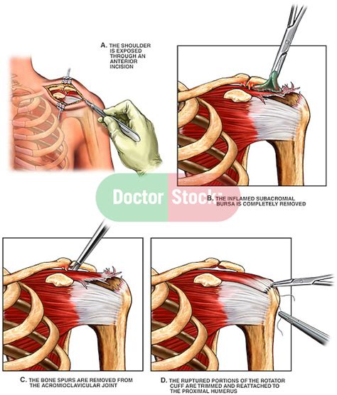 Surgical Acromioplasty, Subacromial Bursectomy and Rotator Cuff Reconstruction | Doctor Stock