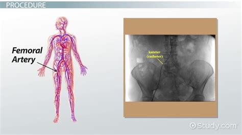 Angiogram Definition, Complications Types Video Lesson, 59% OFF