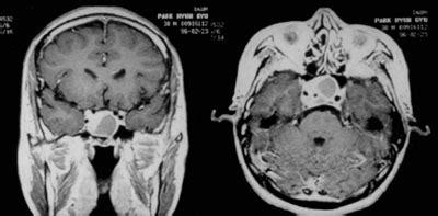 -Pituitary apoplexy – MRI images | Download Scientific Diagram