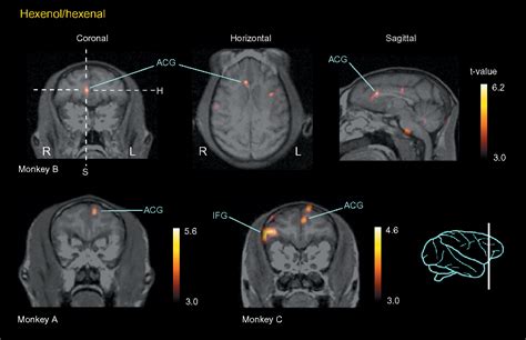 [PDF] Activation of the anterior cingulate gyrus by 'Green Odor': a positron emission tomography ...