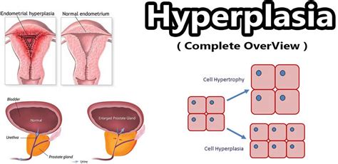 Hyperplasia definition, congenital adrenal, endometrial & prostatic ...