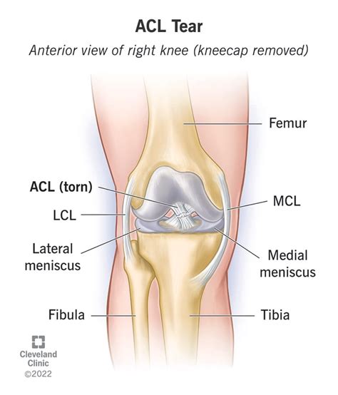 Understanding Anterior Cruciate Ligament (ACL) Injuries - Ask The Nurse Expert