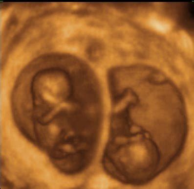 Mc TWINS 11 Weeks! - 3D Ultrasound