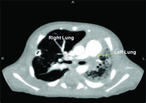 Pulmonary Hypoplasia | Concise Medical Knowledge