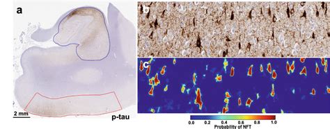 Detection of neurofibrillary tangles (NFT) in phospho-tau (AT8)... | Download Scientific Diagram