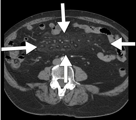 Cureus | Mesenteric Panniculitis: A Rare Condition in a Patient With Rheumatoid Arthritis