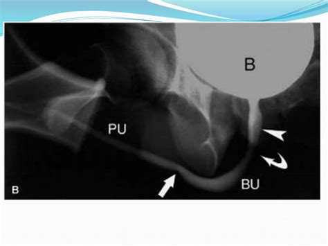 Antegrade & retrograde urethrogram