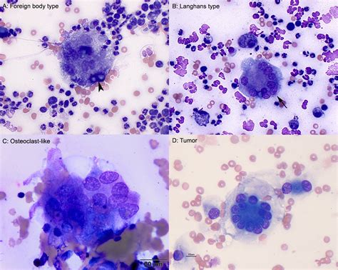 Figure 5: Types of multinucleated giant cells | eClinpath