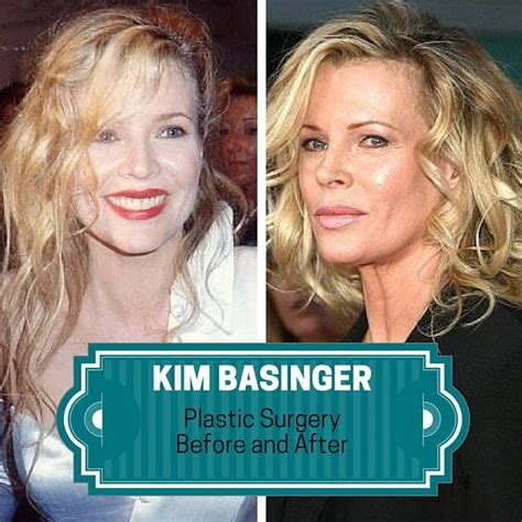 Kim Basinger Plastic Surgery Before and After | Kim basinger, Plastic ...