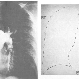 Pulmonary artery angiogram (A) shows complete interruption of the right... | Download Scientific ...