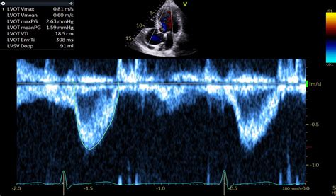 Echocardiography In A Critical Care Setting