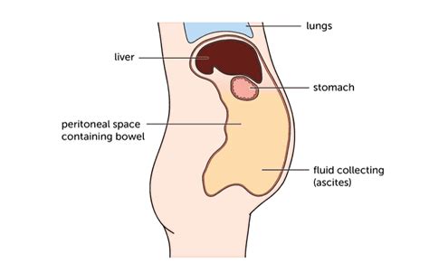 HCC symptoms - Liver Cancer UK