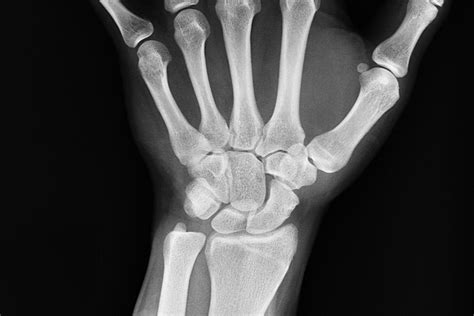 Scaphoid Fracture - Primal Physiotherapy