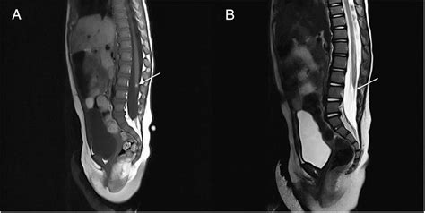 A: MRI T1 4 mm lipoma. B: MRI T2 filum terminale with tethered cord ...