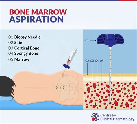 Bone Marrow Biopsy and Bone Marrow Aspiration | CFCH | Centre for Clinical Haematology