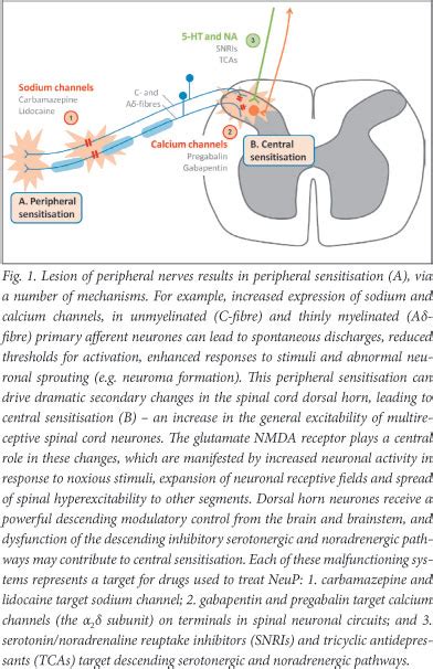 Neuropathic Pain: Central Neuropathic Pain Definition