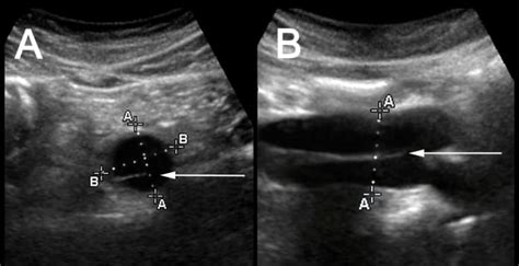 Aortic Dissection Diagnosed by Ultrasound - The Western Journal of Emergency Medicine