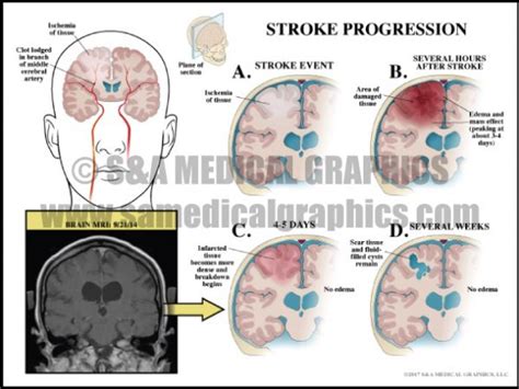 Neurosurgical Complications - S&A Medical Graphics