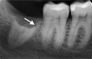 What is the Incidence of Late Complications Associated With Lower Third Molar Coronectomy? 10 ...