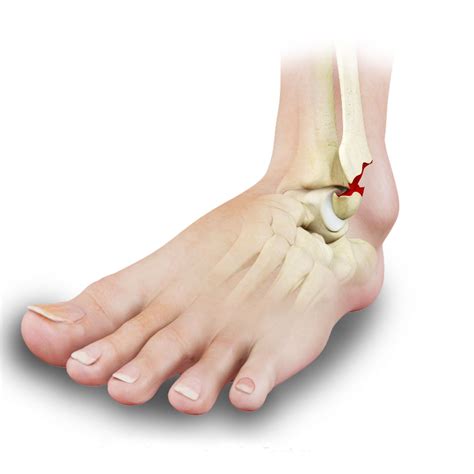 Ankle Fracture Repair Los Angeles | Broken Ankle Glendale | Pasadena