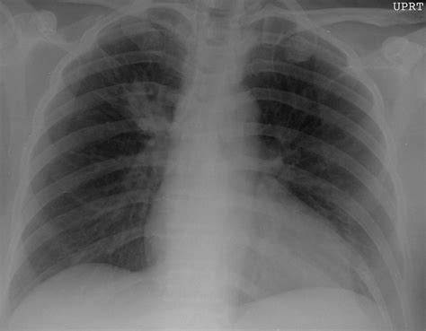 Chest radiography of right suprahilar density. | Download Scientific Diagram