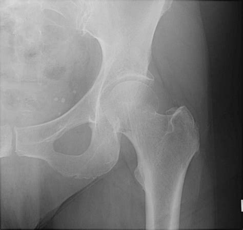 Femoral Neck Fractures - Trauma - Orthobullets