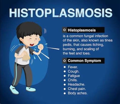 Symptoms of Histoplasmosis - MEDizzy