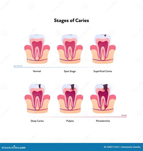 Tooth Anatomy and Decay Chart. Vector Biomedical Illustration. Cross Section Stock Vector ...