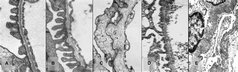 Renal histology in Alport syndrome. ( A ) Normal glomerular ...