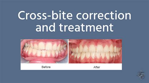 Cross-bite correction and treatment | Tim Chauvin Dental Lafayette La