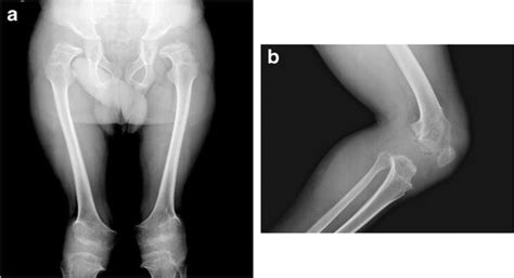 Multiplex dysostosis. An 8-year-old boy with MPS IH. Anteroposterior ...