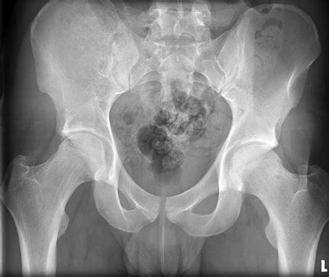 male pelvis x ray normal