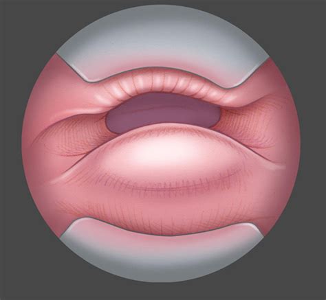 Endoscopic cricopharyngeal myotomy - Operative Techniques in ...