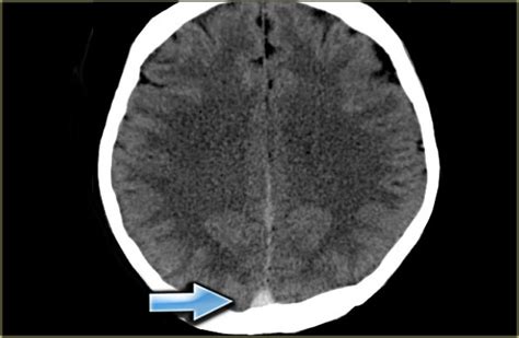 Superior Sagittal Sinus Thrombosis