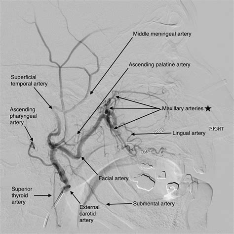 External Carotid Artery Branches Angiogram