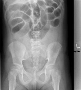 Intestinal Obstruction – Undergraduate Diagnostic Imaging Fundamentals