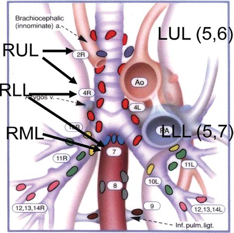 Malignant Mediastinal Lesions | Radiology Key