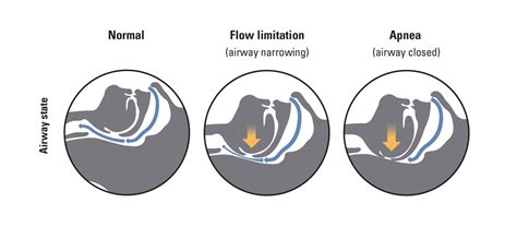 Obstructive Sleep Apnea - Everything You Need to Know