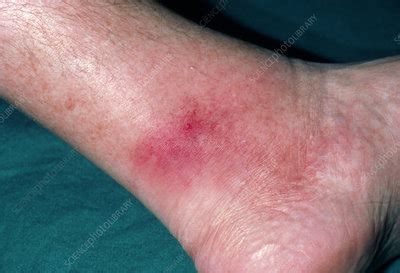 Cellulitis affecting the ankle - Stock Image - M130/0228 - Science Photo Library