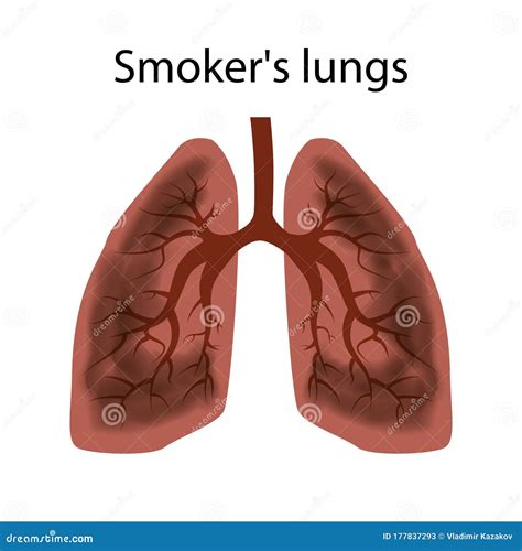 Smoker`s Lungs. Damage To the Lungs of a Person Caused by Smoking Stock Vector - Illustration of ...