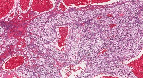 Clear cell renal cell carcinoma | Ottawa Atlas of Pathology