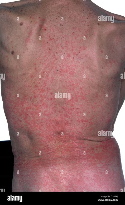 PENICILLIN ALLERGY RASH Stock Photo: 52251238 - Alamy