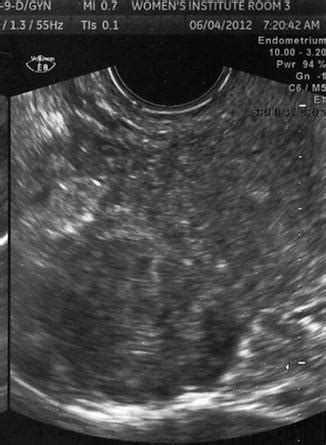 Uterus Fibroid Ultrasound