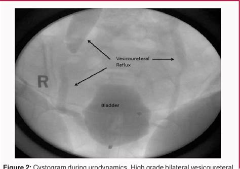 Figure 1 from Common and Uncommon Complications of Autologous Pubovaginal Sling | Semantic Scholar